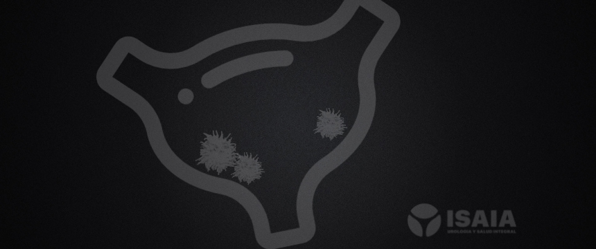 Urología y Salud Integral.. Cáncer de Vejiga