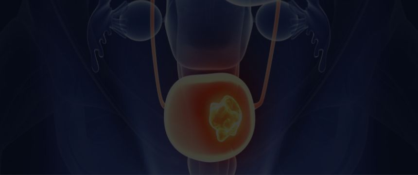 CANCER VESICAL | Urología y Salud Integral.
